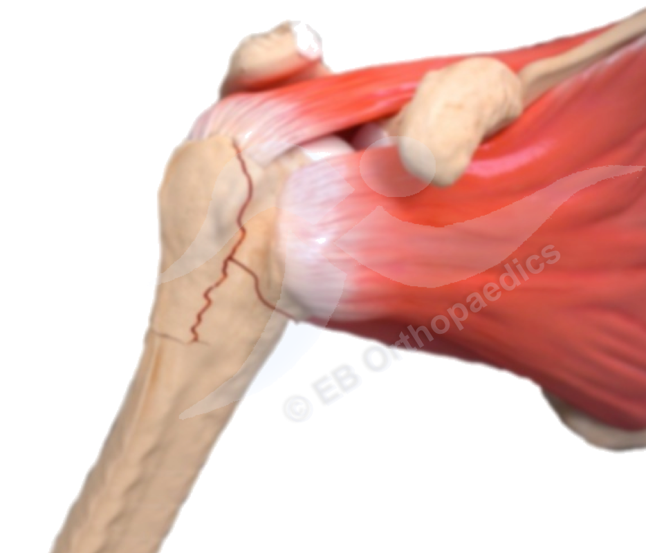 Humerus fractures